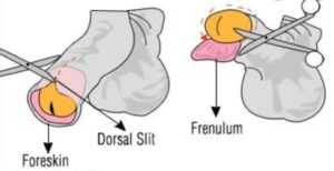 Circumcision